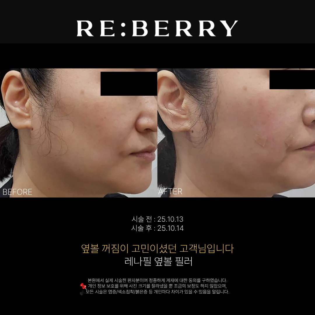 옆볼필러 전후 — 영종도점 김동영원장