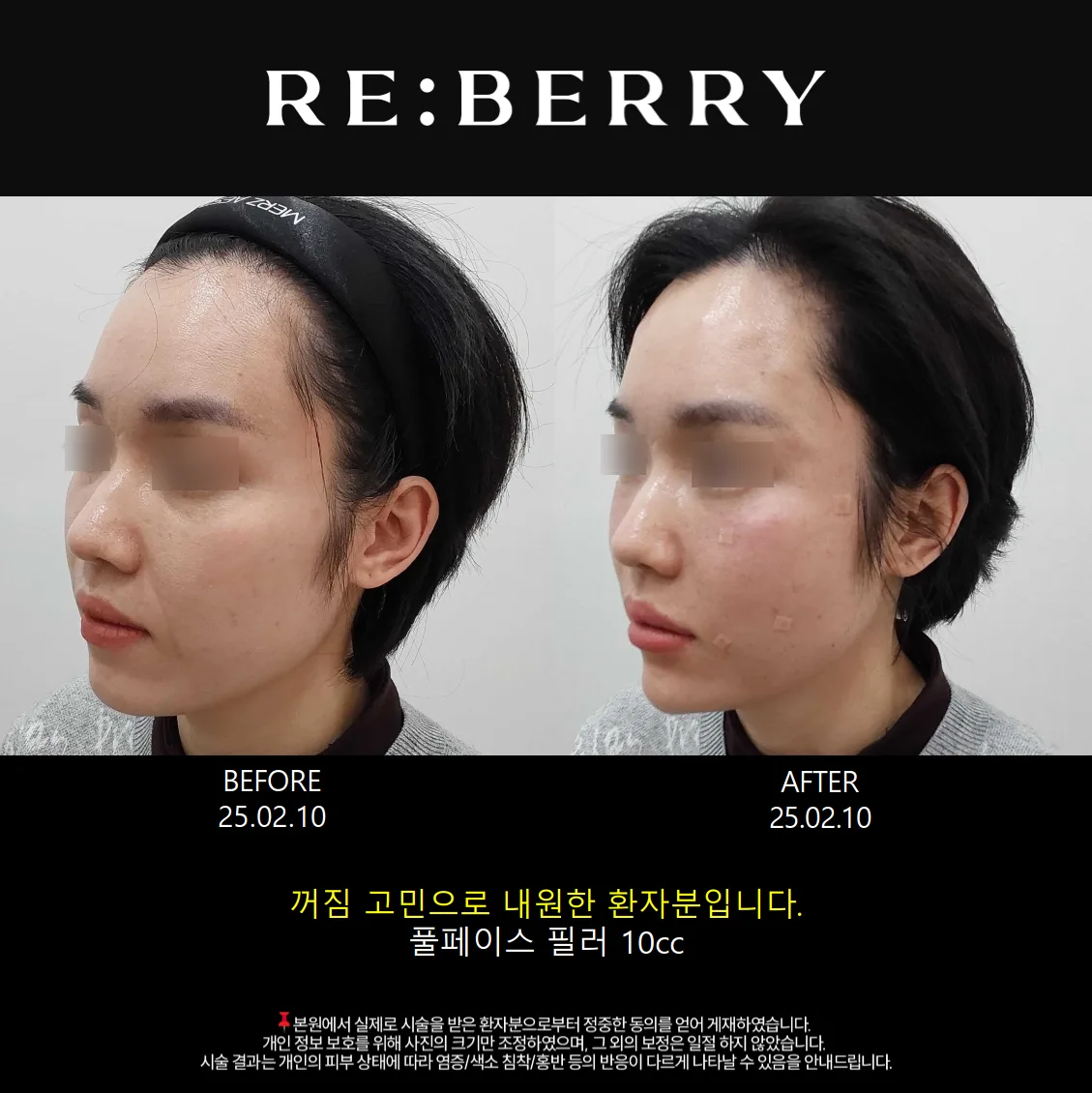 풀페이스필러 전후 — 영종도점 김동영원장