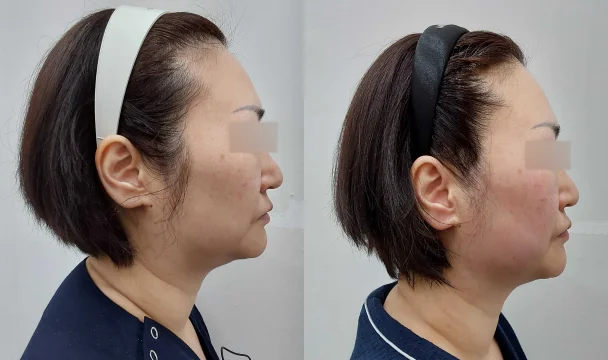 온다+브이로 전후 — 영종도점