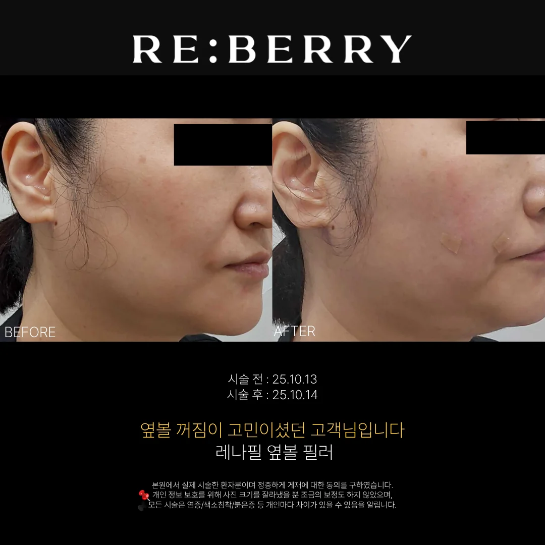 리베리의원 영종도점 시술 전후 사진