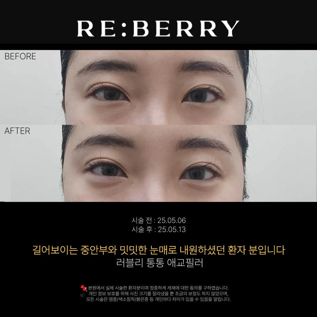 리베리의원 영종도점 시술 전후 사진