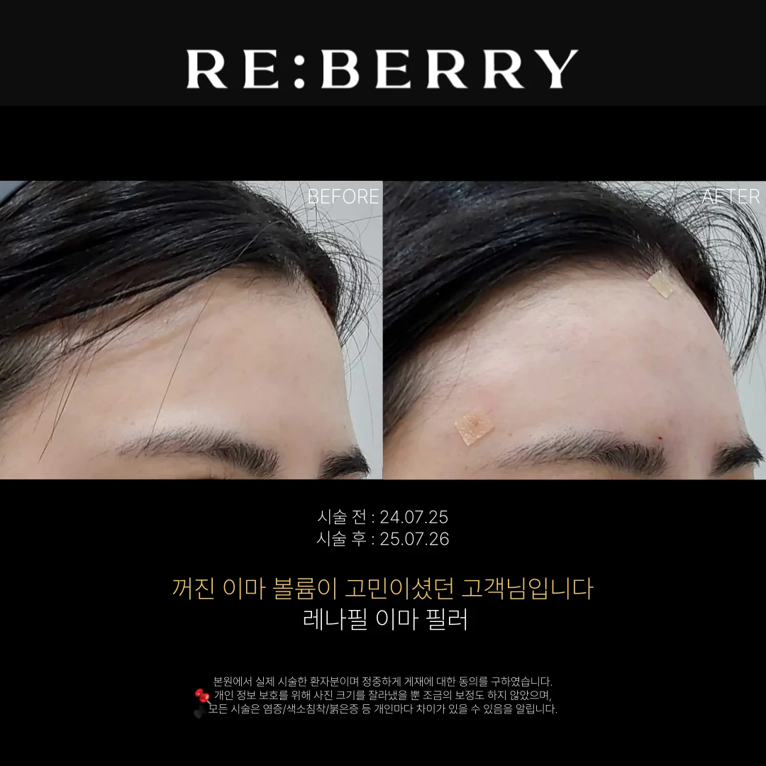 리베리의원 영종도점 시술 전후 사진