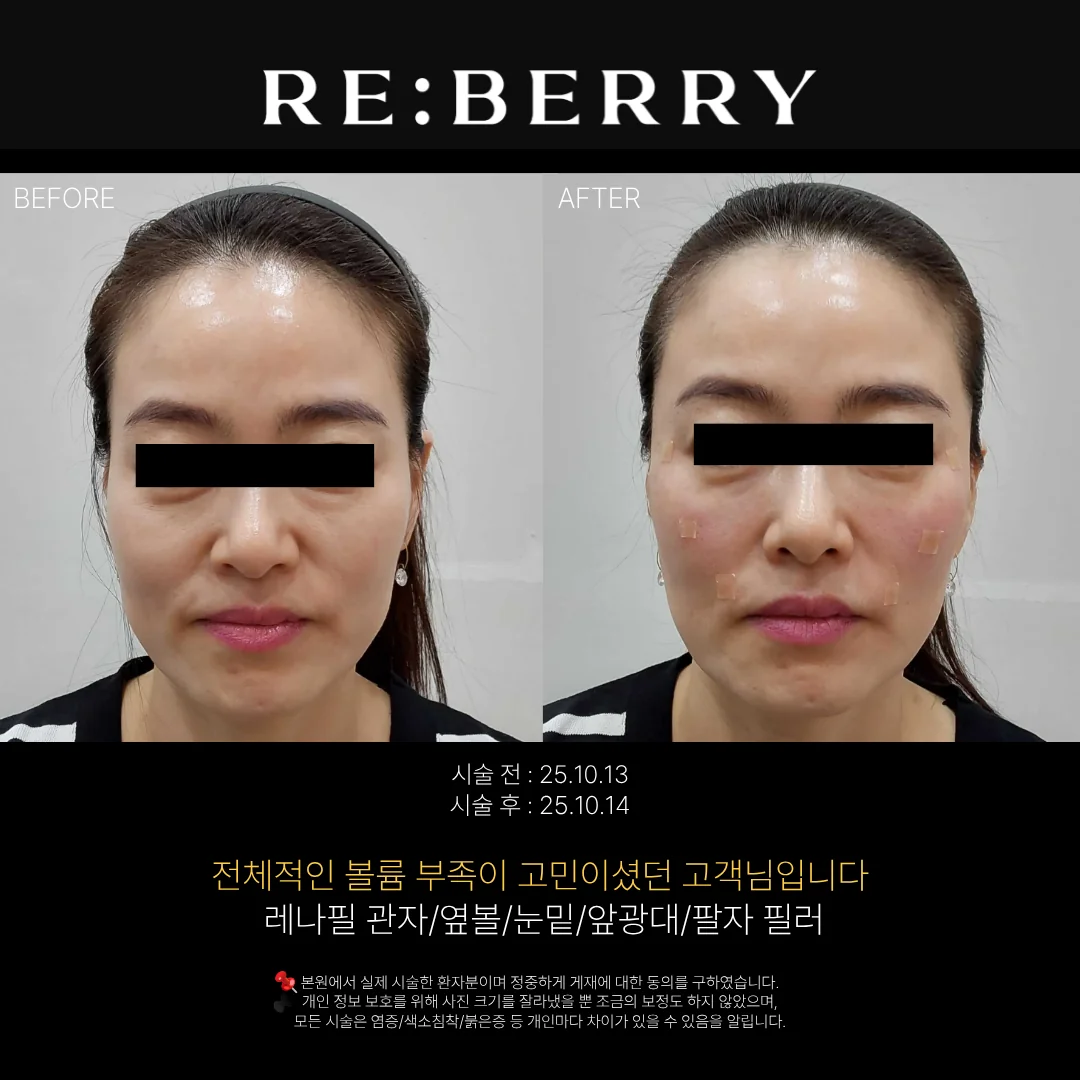 리베리의원 영종도점 시술 전후 사진