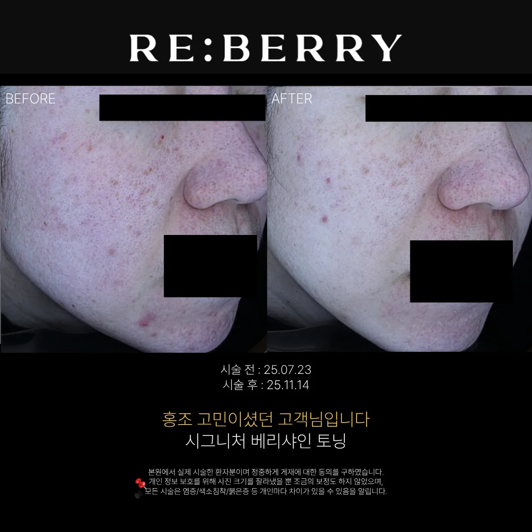 리베리의원 영종도점 시술 전후 사진